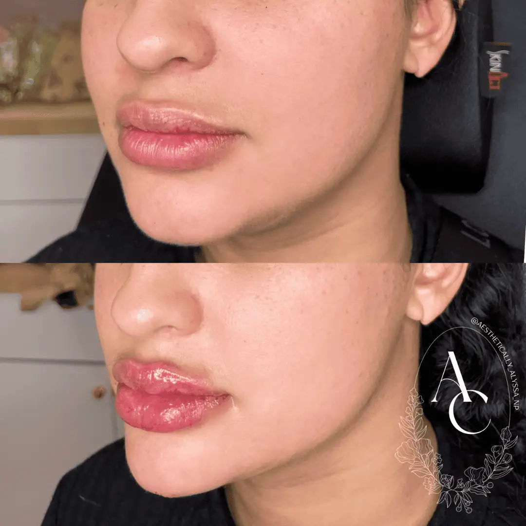 Chin Filler in New York | Timelyss Med Spa