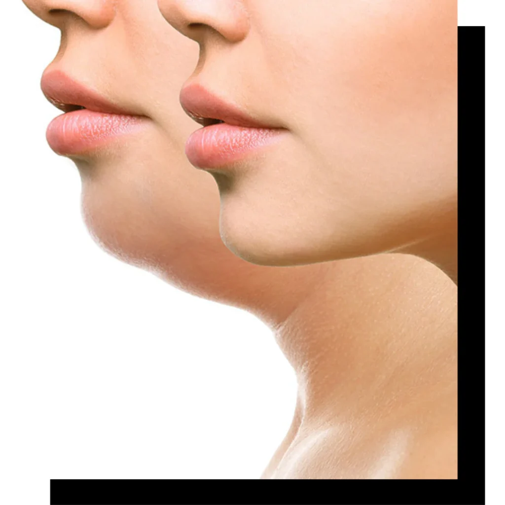 Kybella in New York, NY at TimeLyss Med Spa