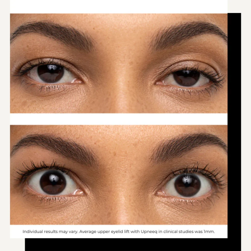 Upneeq Eye Drops in New York | Timelyss Med Spa