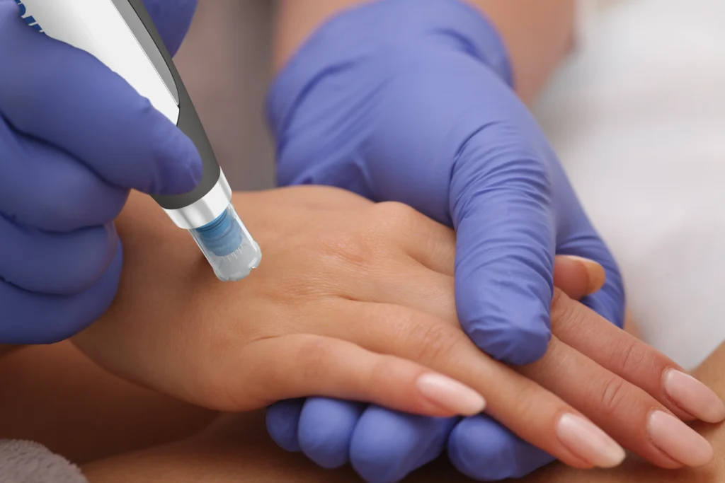 Microneedling in New York by Timelyss Med Spa