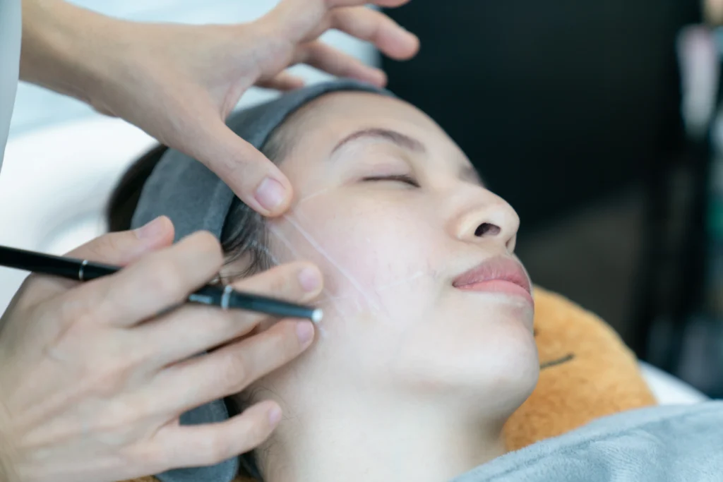 PDO Threads (Miracu) in New York by Timelyss Med Spa