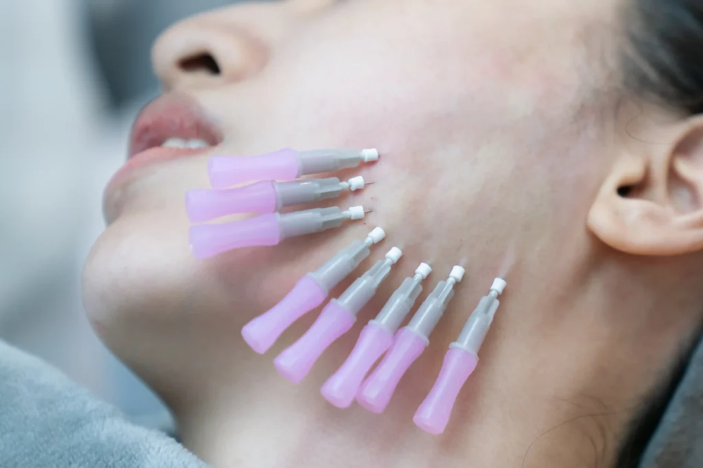 PDO Threads (Miracu) in New York by Timelyss Med Spa