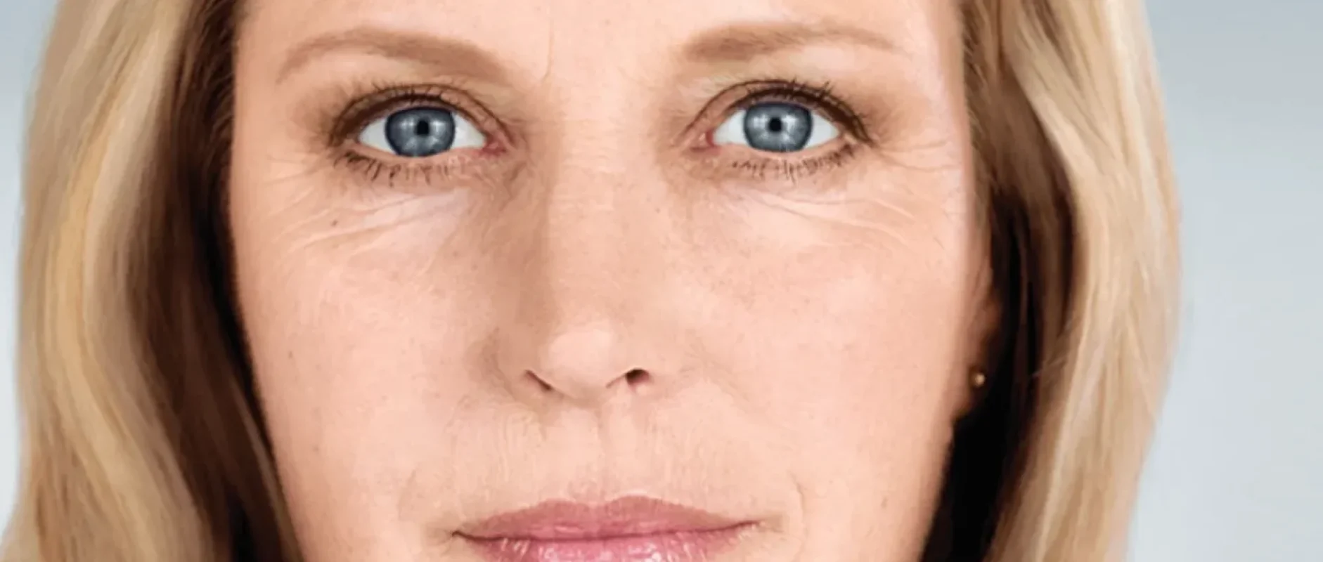 Sculptra Treatment in New York | Timelyss Med Spa